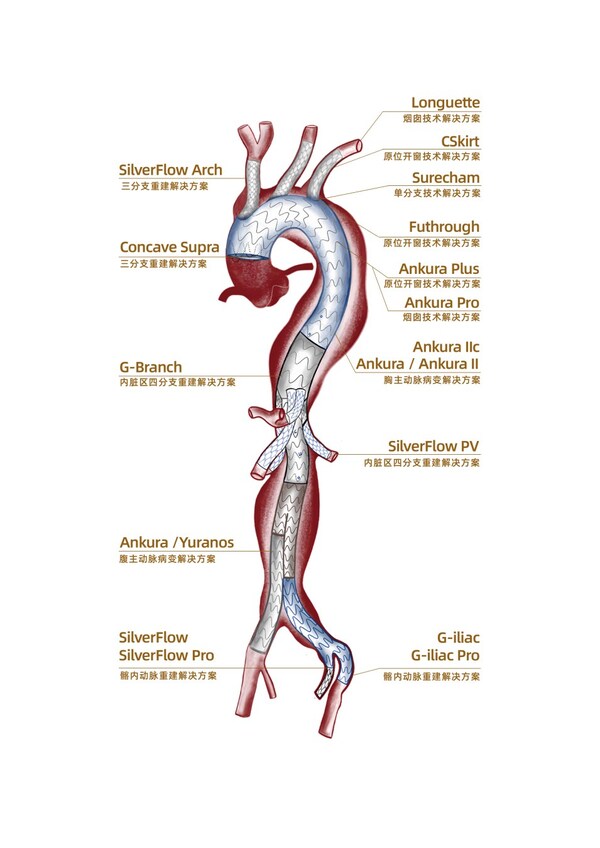 全面升级,NMPA获批 | 先健新一代G-iliac Pro髂动脉覆膜支架系统开启髂内动脉精准重建新篇章 全面升级,NMPA获批 | 先健新一代G-iliac Pro髂动脉覆膜支架系统开启髂内动脉精准重建新篇章