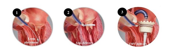 沛嘉医疗授权合作伙伴HighLife SAS研发的HighLifeTSMVR系统斩获欧洲CE认证，引领二尖瓣反流介入治疗新范式