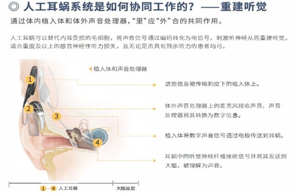 别让孩子在"声音的孤岛"默默长大:0-6岁听损儿童如何追上同龄人的"听觉"脚步 别让孩子在"声音的孤岛"默默长大:0-6岁听损儿童如何追上同龄人的"听觉"脚步